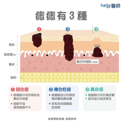 老二長痣|痣形成的原因？痣長毛、痣變多變大是痣病變？5招判別